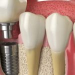 xAre The Cheapest Dental Implants Safe? A Comprehensive Guide