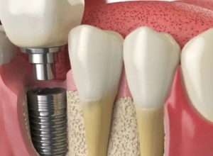xAre The Cheapest Dental Implants Safe? A Comprehensive Guide