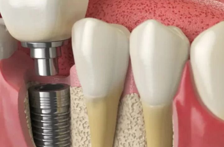 xAre The Cheapest Dental Implants Safe? A Comprehensive Guide