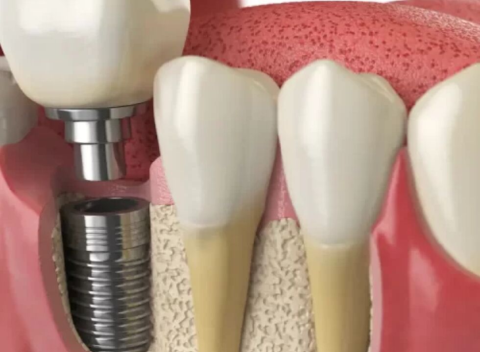 xAre The Cheapest Dental Implants Safe? A Comprehensive Guide